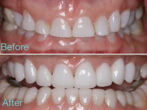 Before and After Veneers - 212 Smilng