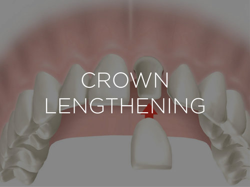 CROWN-LENGTHENING