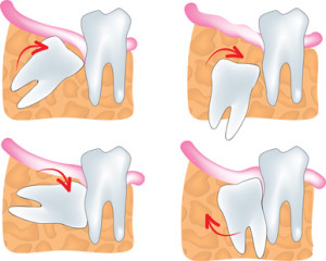 causes for wisdom teeth removal