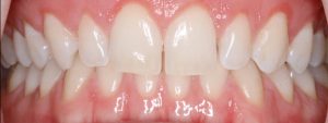 Healthy Gums after treatment