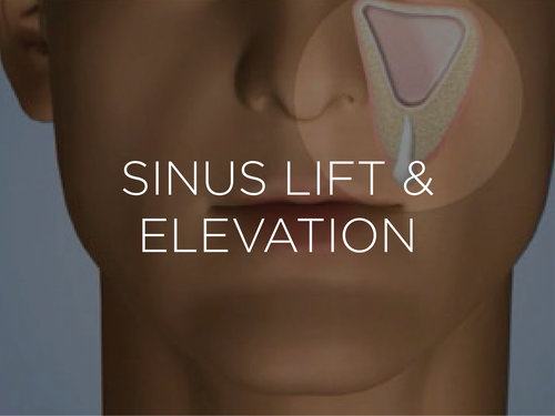 sinus lift surgery