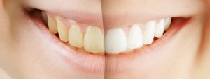 Teeth Whitening Procedure