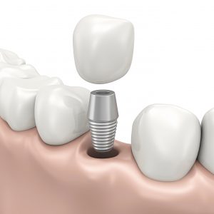 same day dental implants at 212 Smiling