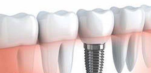 dental implants nyc