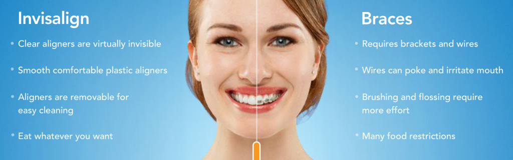 invisalign vs braces