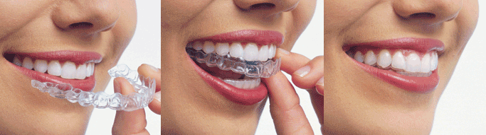 Invisalign Clear Braces at 212 Smiling