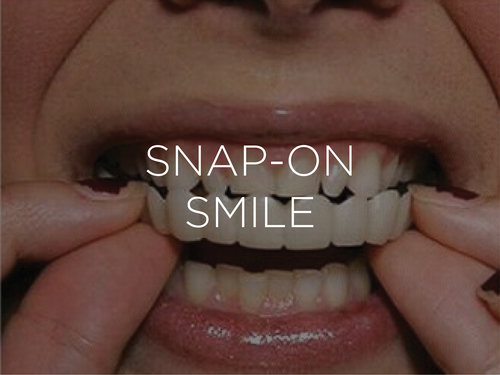 snap on smile