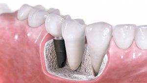 Single Tooth Dental Implant Cost