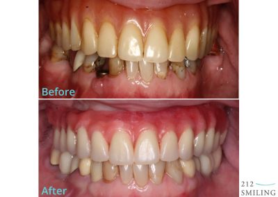 Dental Implants Female