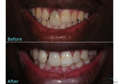 Dental Implants NYC Before And After