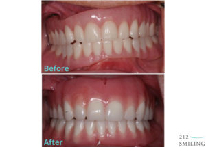 Dentures Female Before And After