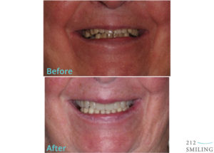 Dentures Male Before And After