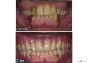 Dentures And Partial Dentures Male Before And After