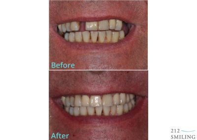 Male Dental Implants Before And After