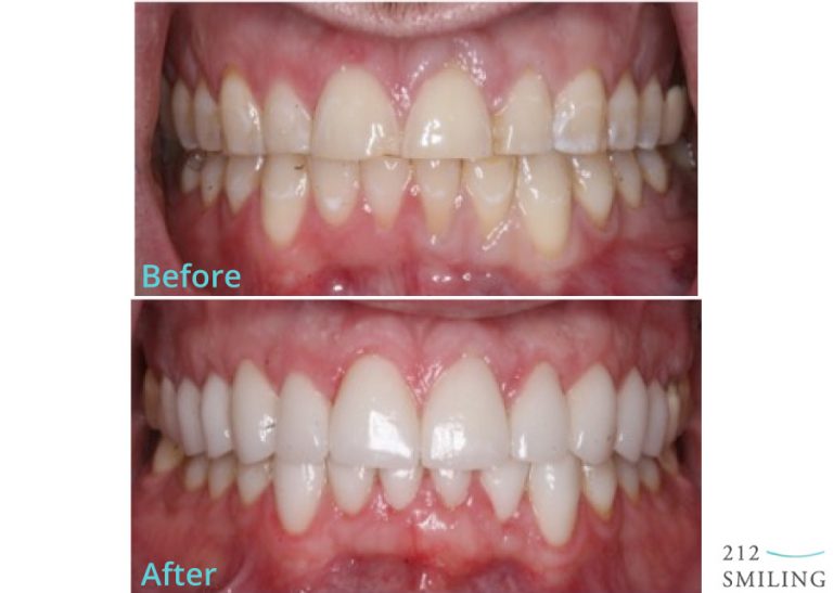 Veneers Before and After Male 212 Smiling