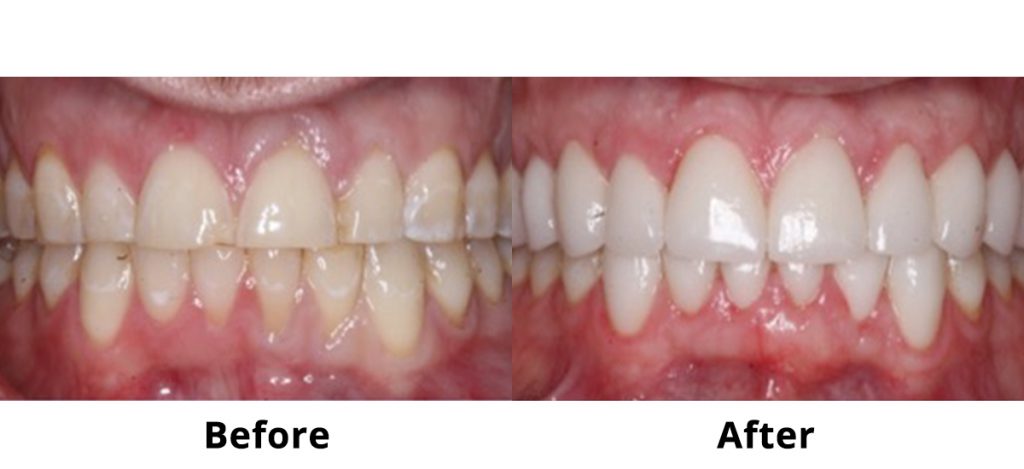 Porcelain Dental Veneers Before and After Male