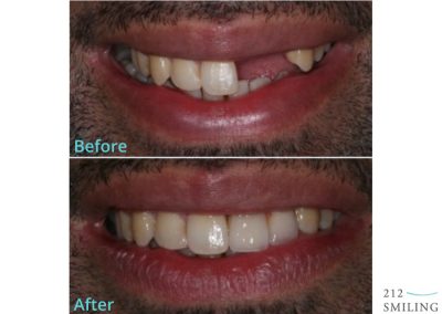 Dental Implants Before And After Male