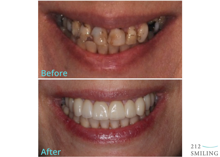 Female All Ceramic Crowns Before and After - 212 Smiling