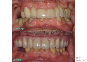 Male All on 4 Before and After