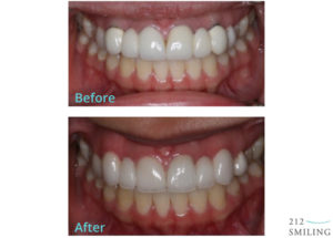 Before and After All Ceramic Bridge