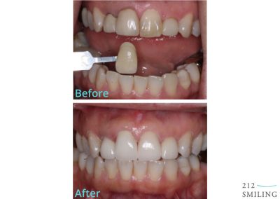 Before After All Ceramic Crowns