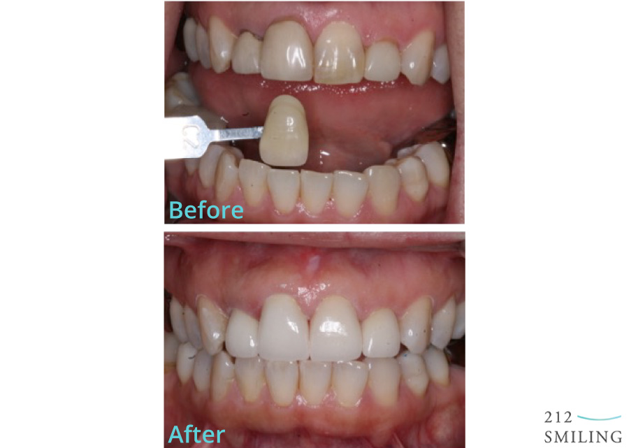 Ceramic Crowns Before and After