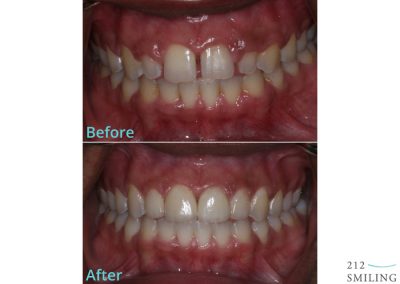 Female Ceramic Veneers Before And After NYC