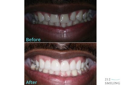 Male Veneers Before And After NYC