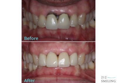 NYC Dental Implant Before After