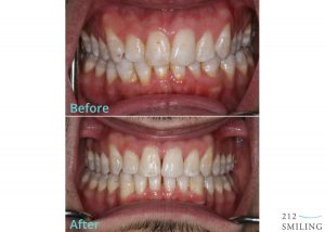 Invisalign Before and After