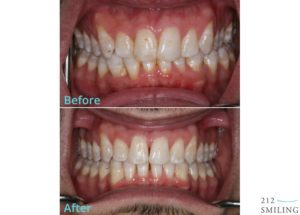 Invisalign Before and After Photos