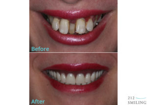 Same Day Dentures Before and After