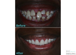 Same Day Dentures Before and After NYC