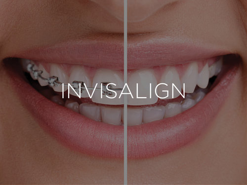 Invisalign Elastics Explained  Savina Dental Clinics (Malta & Gozo)