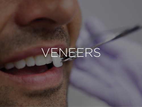 Porcelain Dental Veneers