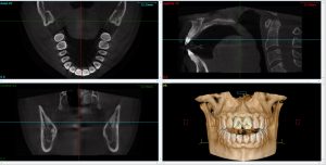 3D Dental Imaging CBCT