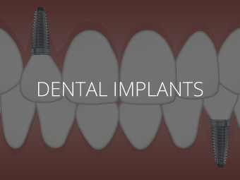 Dental Implants Manhattan