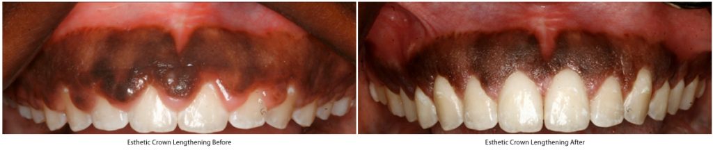 Esthetic Crown Lengthening Before and After