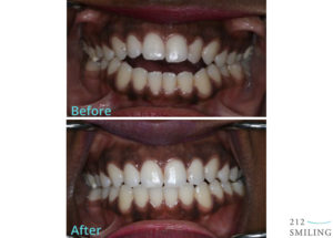 Invisalign Invisible Braces Before After