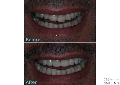 Porcelain Veneers Before And After Photo