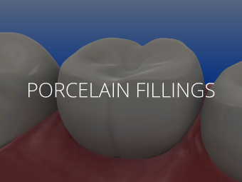 Porcelain Fillings