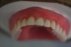 Same Day Denture Close Up