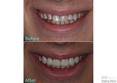 Before And After Photos Porcelain Veneers