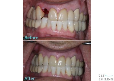 New York Dental Implant Before After