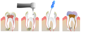 Root Canal Procedure