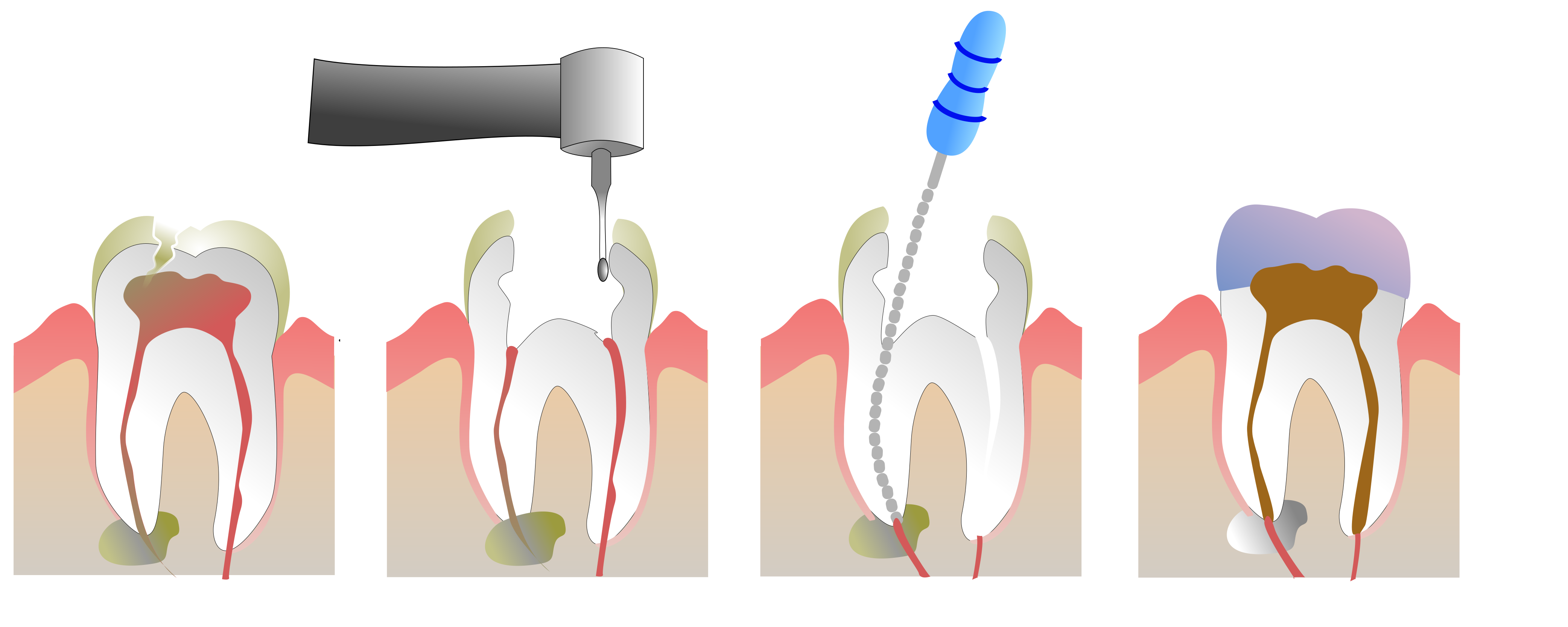 Root canal. 4 Канальный пульпит зуба. Периодонтит 1 канальный. Пульпит витальная экстирпация.