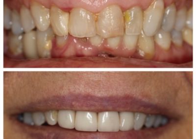 Before And After Female Porcelain Veneers