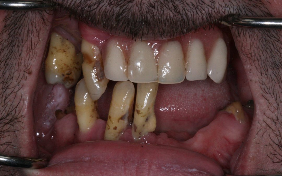All on 4 – Male – Before and After Photos