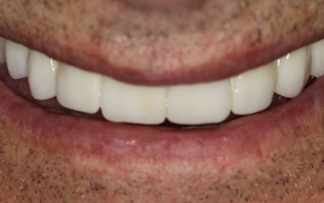 All on 4 – Male – Before and After Photos
