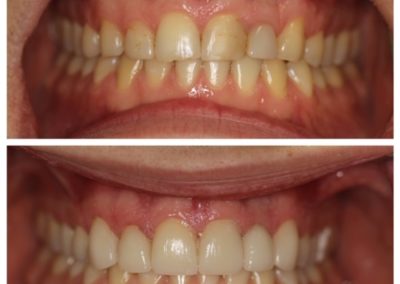 Male Before And After Porcelain Veneers